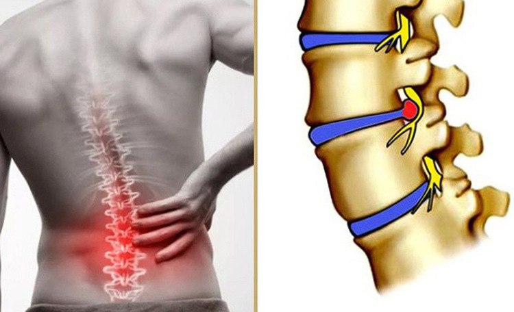 Thoát vị đĩa đệm thắt lưng gây đau lưng lan xuống mông và chân trái hoặc phải